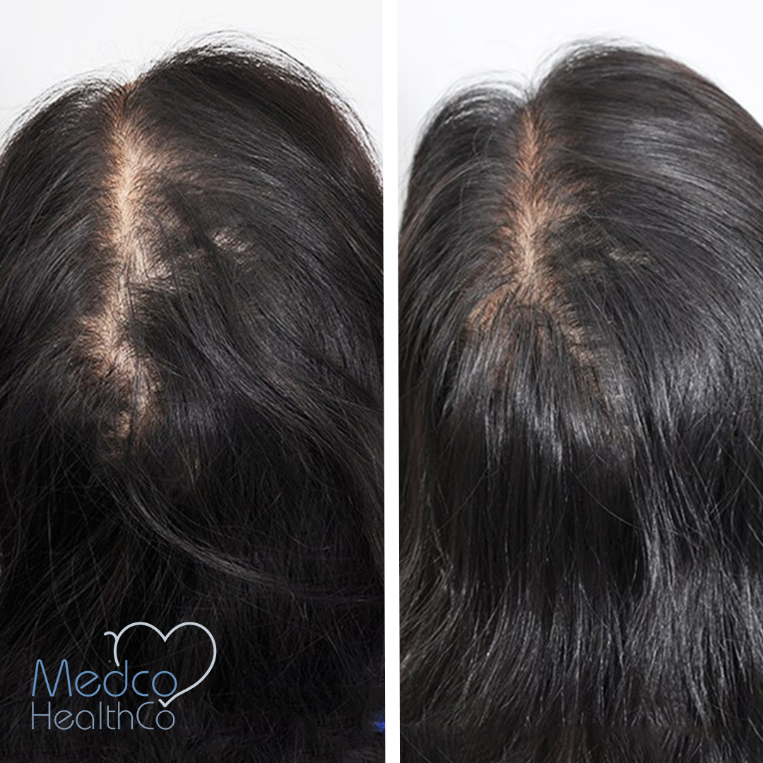 FUE Technique Hair Transplant for Women | Medco Healthco | Stay Safe and  Healthy