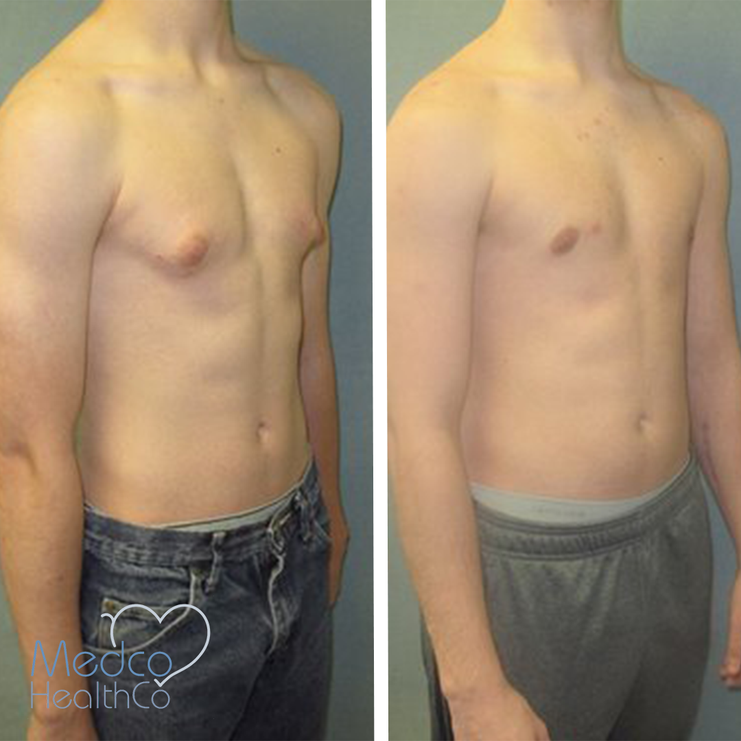 Gynecomastia Surgery Medco Healthco Stay Safe And Healthy 