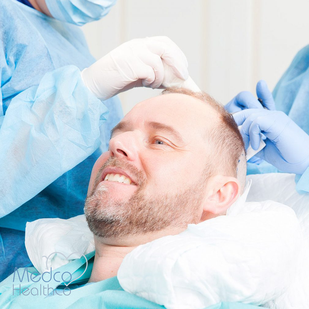 Hair Transplant Guideline | Medco Healthco | Stay Safe and Healthy