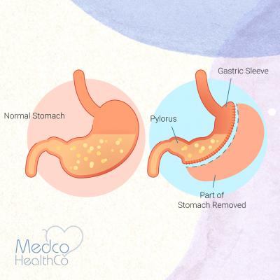 Gastric Sleeve Surgery