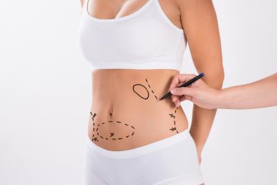 Tummy Tuck